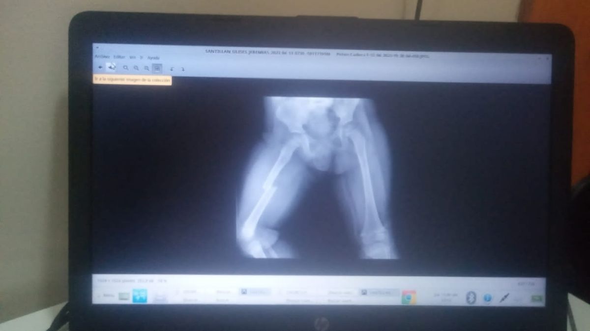Una semana después de tener un accidente, detectan que un niño tiene fractura de fémur